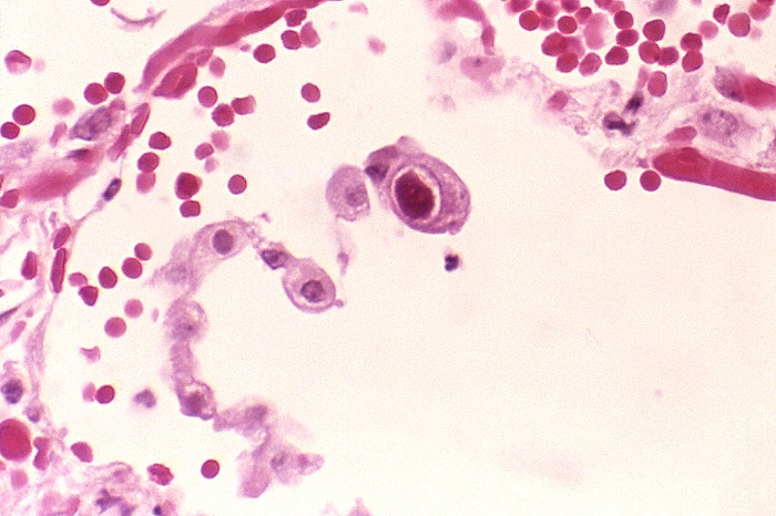 Citomegalovirus sintomi cosa è